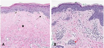 Histopathological differences between vitiligo and lichen sclerosus et atrophicus using quantitative immunohistochemical analysis